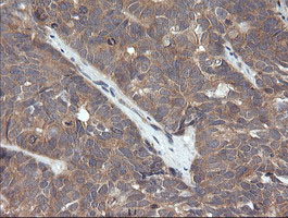 CTAG1B / NY-ESO-1 Antibody - IHC of paraffin-embedded Adenocarcinoma of Human ovary tissue using anti-CTAG1B mouse monoclonal antibody. (Heat-induced epitope retrieval by 10mM citric buffer, pH6.0, 120°C for 3min).