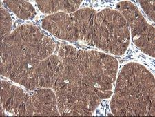 CTAG1B / NY-ESO-1 Antibody - IHC of paraffin-embedded Adenocarcinoma of Human ovary tissue using anti-CTAG1B mouse monoclonal antibody.