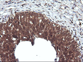 CTAG1B / NY-ESO-1 Antibody - IHC of paraffin-embedded Human bladder tissue using anti-CTAG1B mouse monoclonal antibody.