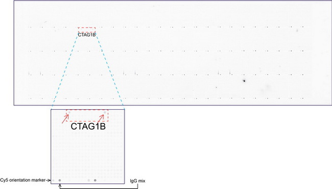 CTAG1B / NY-ESO-1 Antibody - OriGene overexpression protein microarray chip was immunostained with UltraMAB anti-CTAG1B mouse monoclonal antibody. The positive reactive proteins are highlighted with two red arrows in the enlarged subarray. All the positive controls spotted in this subarray are also labeled for clarification.