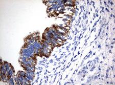 CTAG1B / NY-ESO-1 Antibody - Immunohistochemical staining of paraffin-embedded Human testicular cancer tissue using anti-CTAG1B mouse monoclonal antibody.  heat-induced epitope retrieval by 10mM citric buffer, pH6.0, 120C for 3min)
