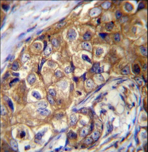 CTAGE5 Antibody - CTAGE5 Antibody immunohistochemistry of formalin-fixed and paraffin-embedded human breast carcinoma followed by peroxidase-conjugated secondary antibody and DAB staining.