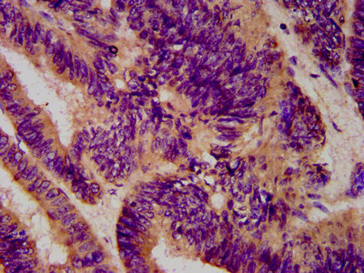 CTAGE5 Antibody - Immunohistochemistry Dilution at 1:600 and staining in paraffin-embedded human colon cancer performed on a Leica BondTM system. After dewaxing and hydration, antigen retrieval was mediated by high pressure in a citrate buffer (pH 6.0). Section was blocked with 10% normal Goat serum 30min at RT. Then primary antibody (1% BSA) was incubated at 4°C overnight. The primary is detected by a biotinylated Secondary antibody and visualized using an HRP conjugated SP system.