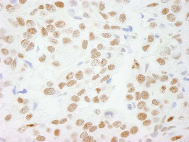 CTBP1 / CTBP Antibody - Detection of Human CTBP1 by Immunohistochemistry. Sample: FFPE section of human breast adenocarcinoma. Antibody: Affinity purified rabbit anti-CTBP1 used at a dilution of 1:100.