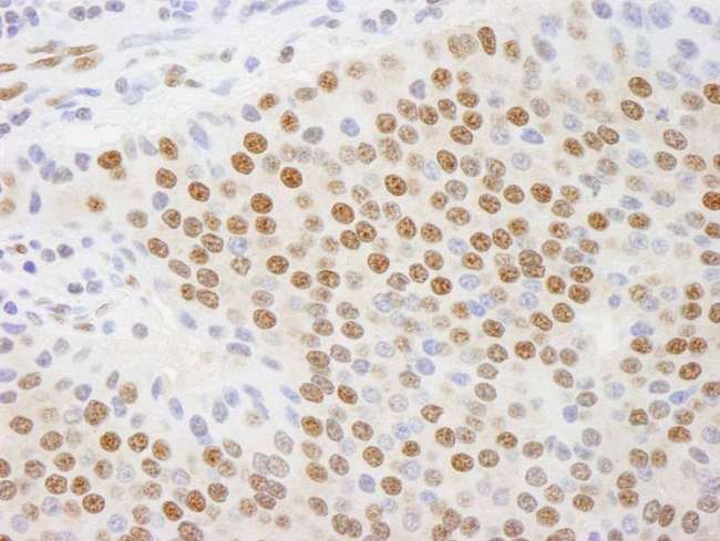 CTBP1 / CTBP Antibody - Detection of Human CTBP1 by Immunohistochemistry. Sample: FFPE section of human islet cell tumor. Antibody: Affinity purified rabbit anti-CTBP1 used at a dilution of 1:100.
