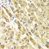 CTBP1 / CTBP Antibody - Immunohistochemistry of paraffin-embedded human liver cancer using CTBP1 antibodyat dilution of 1:100 (40x lens).