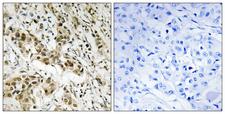 CTBP1 / CTBP Antibody - Peptide - + Immunohistochemistry analysis of paraffin-embedded human breast carcinoma tissue using CtBP1 (Ab-422) antibody.