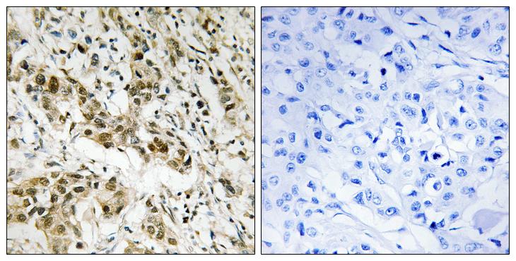 CTBP1 / CTBP Antibody - Peptide - + Immunohistochemistry analysis of paraffin-embedded human breast carcinoma tissue using CtBP1 (Ab-422) antibody.