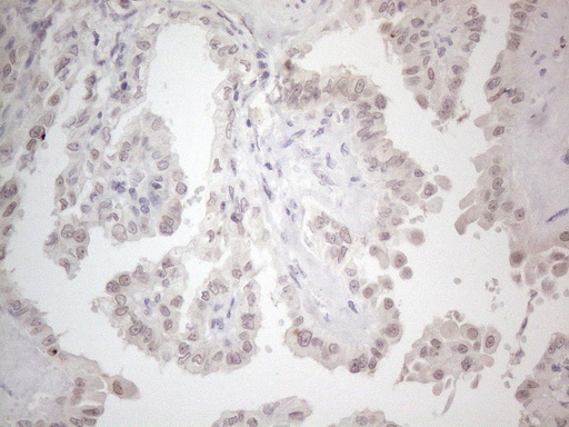 CTBP2 Antibody - Immunohistochemical staining of paraffin-embedded Carcinoma of Human thyroid tissue using anti-CTBP2 mouse monoclonal antibody. (Heat-induced epitope retrieval by 1mM EDTA in 10mM Tris buffer. (pH8.5) at 120°C for 3 min. (1:150)