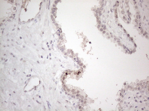 CTBP2 Antibody - Immunohistochemical staining of paraffin-embedded Carcinoma of Human prostate tissue using anti-CTBP2 mouse monoclonal antibody. (Heat-induced epitope retrieval by 1mM EDTA in 10mM Tris buffer. (pH8.5) at 120°C for 3 min. (1:150)