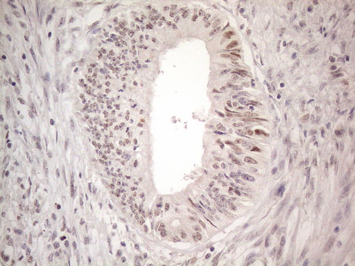 CTBP2 Antibody - Immunohistochemical staining of paraffin-embedded Adenocarcinoma of Human colon tissue using anti-CTBP2 mouse monoclonal antibody. (Heat-induced epitope retrieval by 1mM EDTA in 10mM Tris buffer. (pH8.5) at 120°C for 3 min. (1:150)