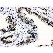 CTBP2 Antibody - CTBP2 antibody IHC-paraffin. IHC(P): Human Intestinal Cancer Tissue.