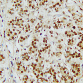 CTBP2 Antibody - CTBP2 antibody. IHC(P):Human Breast Cancer Tissue.