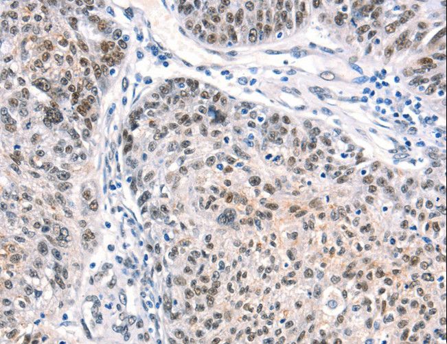 CTBP2 Antibody - Immunohistochemistry of paraffin-embedded Human ovarian cancer using CTBP2 Polyclonal Antibody at dilution of 1:40.