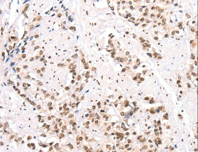 CTBP2 Antibody - Immunohistochemistry of paraffin-embedded Human prostate cancer using CTBP2 Polyclonal Antibody at dilution of 1:40.