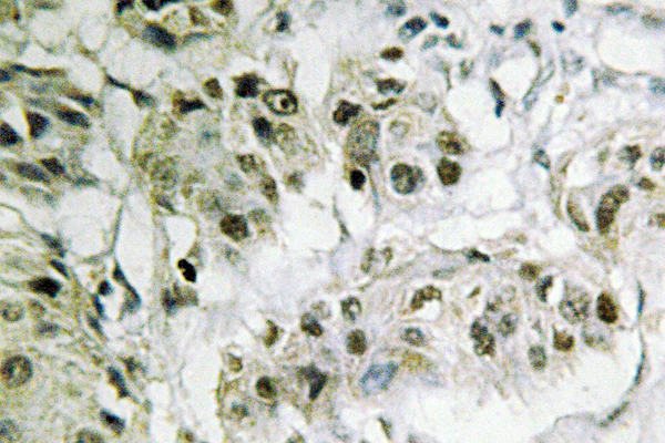 CTBP2 Antibody - IHC of CtBP2 (P432) pAb in paraffin-embedded human breast carcinoma tissue.