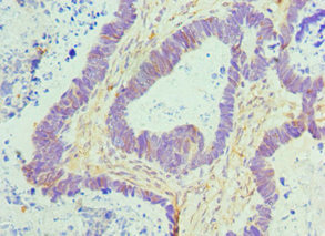 CTCF Antibody - Immunohistochemistry of paraffin-embedded human ovarian cancer using CTCF Antibody at dilution of 1:100
