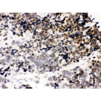 CTCF Antibody - CTCF antibody IHC-paraffin. IHC(P): Human Lung Cancer Tissue.