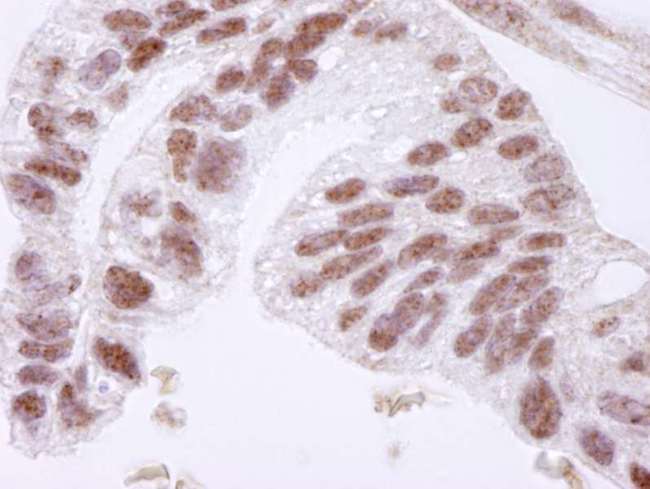 CTCF Antibody - Detection of Human CTCF by Immunohistochemistry. Sample: FFPE section of human ovarian carcinoma. Antibody: Affinity purified rabbit anti-CTCF used at a dilution of 1:250. Detection: DAB.