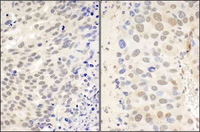 CTCF Antibody - Detection of Human and Mouse by Immunohistochemistry. Sample: FFPE sections of human ovarian carcinoma (left) and mouse renal cell carcinoma (right). Antibody: Affinity purified rabbit anti- used at a dilution of 1:100 (2 Detection: DAB.