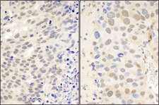 CTCF Antibody - Detection of Human and Mouse by Immunohistochemistry. Sample: FFPE sections of human ovarian carcinoma (left) and mouse renal cell carcinoma (right). Antibody: Affinity purified rabbit anti- used at a dilution of 1:100 (2 Detection: DAB.