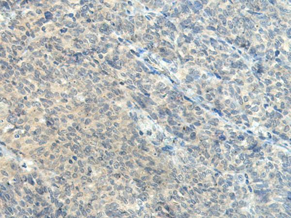 CTDP1 / FCP1 Antibody - Immunohistochemistry of paraffin-embedded Human ovarian cancer tissue  using CTDP1 Polyclonal Antibody at dilution of 1:55(×200)