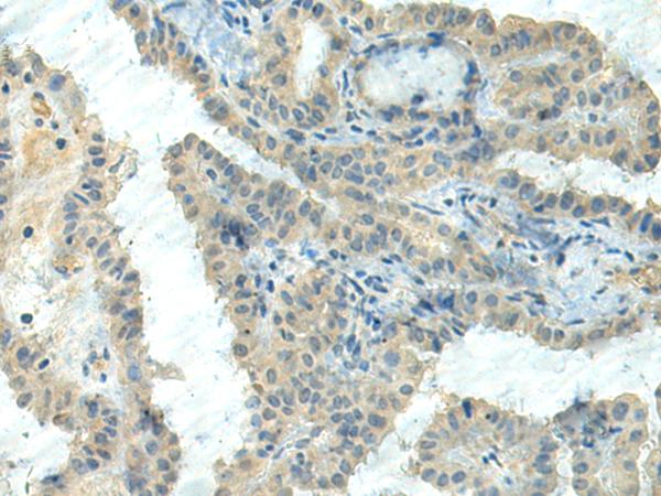 CTDP1 / FCP1 Antibody - Immunohistochemistry of paraffin-embedded Human thyroid cancer tissue  using CTDP1 Polyclonal Antibody at dilution of 1:55(×200)