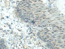 CTDP1 / FCP1 Antibody - Immunohistochemistry of paraffin-embedded Human esophagus cancer tissue  using CTDP1 Polyclonal Antibody at dilution of 1:70(×200)