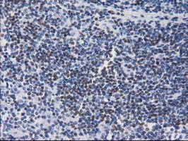 CTDSP1 / SCP1 Antibody - IHC of paraffin-embedded Human lymphoma tissue using anti-CTDSP1 mouse monoclonal antibody.