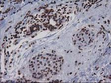 CTDSP1 / SCP1 Antibody - IHC of paraffin-embedded Adenocarcinoma of Human breast tissue using anti-CTDSP1 mouse monoclonal antibody.