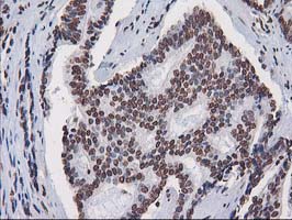 CTDSP1 / SCP1 Antibody - IHC of paraffin-embedded Carcinoma of Human prostate tissue using anti-CTDSP1 mouse monoclonal antibody.