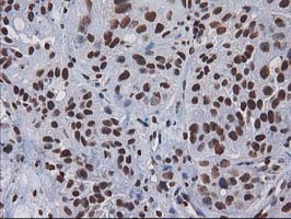 CTDSP1 / SCP1 Antibody - IHC of paraffin-embedded Carcinoma of Human bladder tissue using anti-CTDSP1 mouse monoclonal antibody.