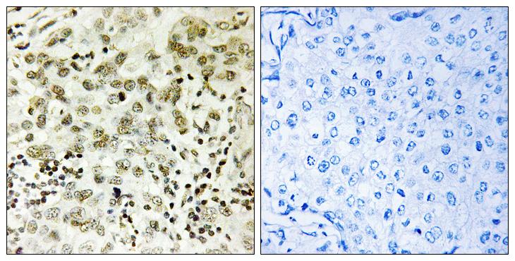 CTDSP1 / SCP1 Antibody - Peptide - + Immunohistochemistry analysis of paraffin-embedded human breast carcinoma tissue, using CTDSP1 antibody.