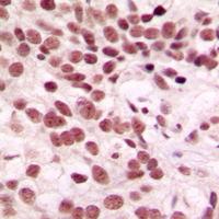 CTDSP1 / SCP1 Antibody - Immunohistochemical analysis of CTDSP1 staining in human breast cancer formalin fixed paraffin embedded tissue section. The section was pre-treated using heat mediated antigen retrieval with sodium citrate buffer (pH 6.0). The section was then incubated with the antibody at room temperature and detected using an HRP conjugated compact polymer system. DAB was used as the chromogen. The section was then counterstained with hematoxylin and mounted with DPX.