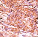 CTDSP2 Antibody - Formalin-fixed and paraffin-embedded human cancer tissue reacted with the primary antibody, which was peroxidase-conjugated to the secondary antibody, followed by AEC staining. This data demonstrates the use of this antibody for immunohistochemistry; clinical relevance has not been evaluated. BC = breast carcinoma; HC = hepatocarcinoma.