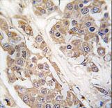 CTDSP2 Antibody - Formalin-fixed and paraffin-embedded human breast carcinoma tissue reacted with CTDSP2 Antibody , which was peroxidase-conjugated to the secondary antibody, followed by DAB staining. This data demonstrates the use of this antibody for immunohistochemistry; clinical relevance has not been evaluated.