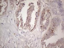 CTDSP2 Antibody - Immunohistochemical staining of paraffin-embedded Adenocarcinoma of Human ovary tissue using anti-CTDSP2 mouse monoclonal antibody. (Heat-induced epitope retrieval by 1mM EDTA in 10mM Tris buffer. (pH8.5) at 120°C for 3 min. (1:150)