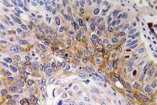CTF1 / Cardiotrophin-1 Antibody - IHC of Cardiotrophin-1 (H31) pAb in paraffin-embedded human lung carcinoma tissue.