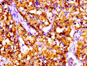 CTF1 / Cardiotrophin-1 Antibody - Immunohistochemistry image at a dilution of 1:100 and staining in paraffin-embedded human adrenal gland tissue performed on a Leica BondTM system. After dewaxing and hydration, antigen retrieval was mediated by high pressure in a citrate buffer (pH 6.0) . Section was blocked with 10% normal goat serum 30min at RT. Then primary antibody (1% BSA) was incubated at 4 °C overnight. The primary is detected by a biotinylated secondary antibody and visualized using an HRP conjugated SP system.