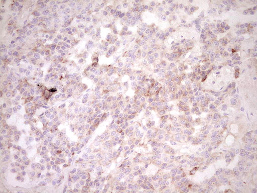 CTGF Antibody - Immunohistochemical staining of paraffin-embedded Carcinoma of Human lung tissue using anti-CTGF mouse monoclonal antibody. (Heat-induced epitope retrieval by 1 mM EDTA in 10mM Tris, pH8.5, 120C for 3min,