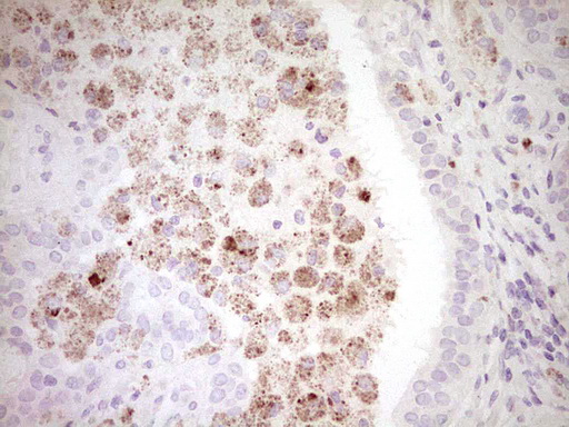 CTGF Antibody - Immunohistochemical staining of paraffin-embedded Adenocarcinoma of Human breast tissue using anti-CTGF mouse monoclonal antibody. (Heat-induced epitope retrieval by 1 mM EDTA in 10mM Tris, pH8.5, 120C for 3min,