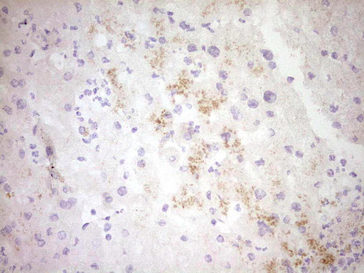 CTGF Antibody - IHC of paraffin-embedded Human liver tissue using anti-CTGF mouse monoclonal antibody. (Heat-induced epitope retrieval by 1 mM EDTA in 10mM Tris, pH8.5, 120°C for 3min).