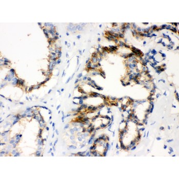 CTGF Antibody - CTGF antibody IHC-paraffin. IHC(P): Human Mammary Cancer Tissue.