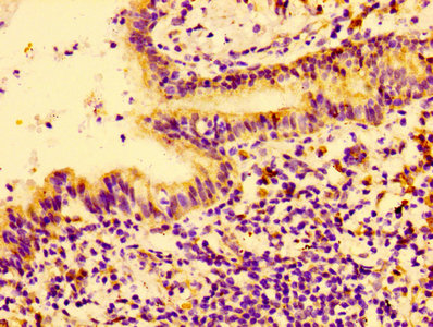 CTGF Antibody - Immunohistochemistry of paraffin-embedded human lung cancer using CTGF Antibody at dilution of 1:100