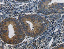 CTGF Antibody - Immunohistochemistry of paraffin-embedded Human cervical cancer using CTGF Polyclonal Antibody at dilution of 1:50.