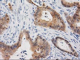 CTH / Cystathionase Antibody - IHC of paraffin-embedded Adenocarcinoma of Human colon tissue using anti-CTH mouse monoclonal antibody. (Heat-induced epitope retrieval by 10mM citric buffer, pH6.0, 100C for 10min).