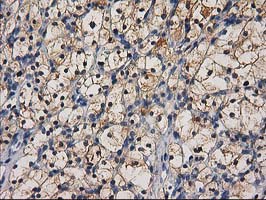 CTH / Cystathionase Antibody - IHC of paraffin-embedded Carcinoma of Human kidney tissue using anti-CTH mouse monoclonal antibody. (Heat-induced epitope retrieval by 10mM citric buffer, pH6.0, 100C for 10min).
