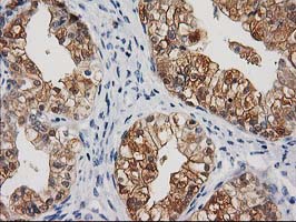 CTH / Cystathionase Antibody - IHC of paraffin-embedded Adenocarcinoma of Human ovary tissue using anti-CTH mouse monoclonal antibody. (Heat-induced epitope retrieval by 10mM citric buffer, pH6.0, 100C for 10min).