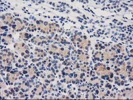CTH / Cystathionase Antibody - IHC of paraffin-embedded Carcinoma of Human thyroid tissue using anti-CTH mouse monoclonal antibody. (Heat-induced epitope retrieval by 10mM citric buffer, pH6.0, 100C for 10min).