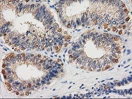 CTH / Cystathionase Antibody - IHC of paraffin-embedded Adenocarcinoma of Human endometrium tissue using anti-CTH mouse monoclonal antibody. (Heat-induced epitope retrieval by 10mM citric buffer, pH6.0, 100C for 10min).
